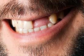 edentulia caduta denti